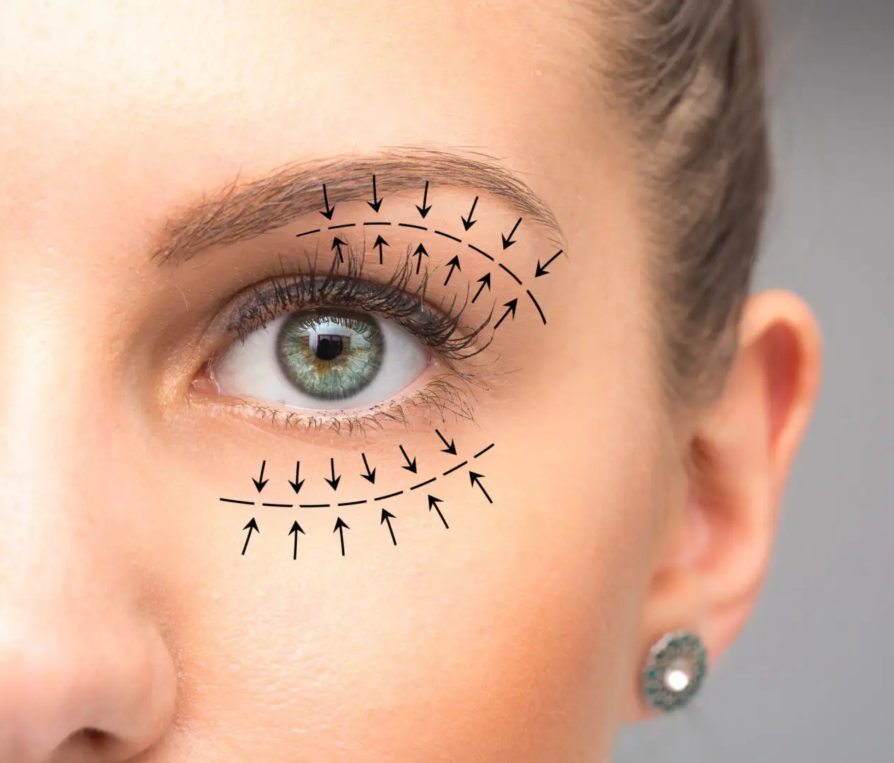 Blepharoplasty
