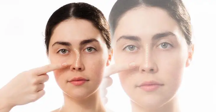 Septoplasty