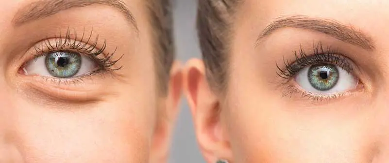 Combined rhinoplasty and blepharoplasty procedure