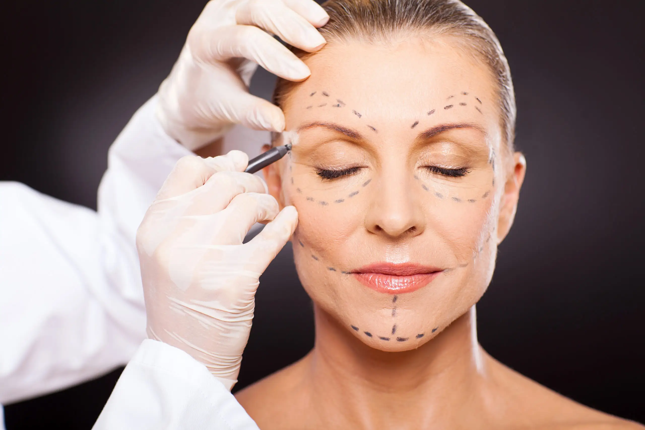 Blepharoplasty