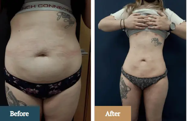 Liposuction Recovery Nurse