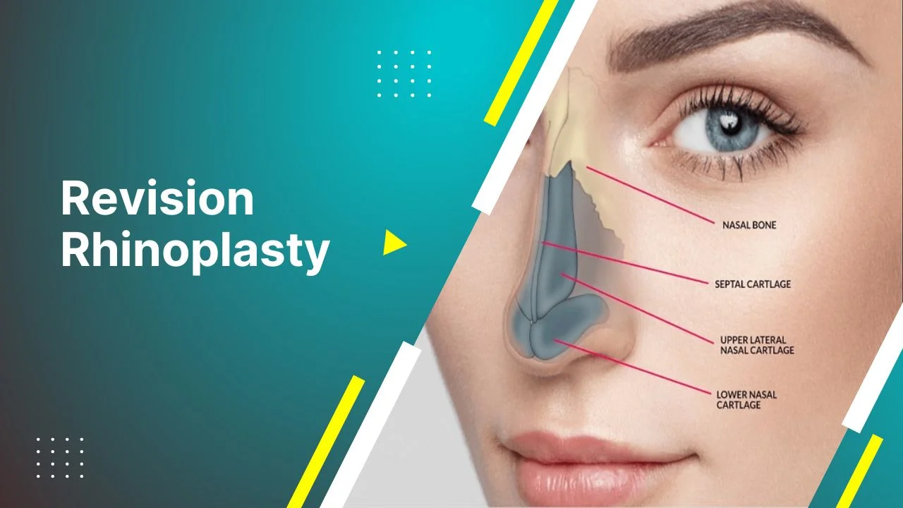 Before and after revision rhinoplasty results