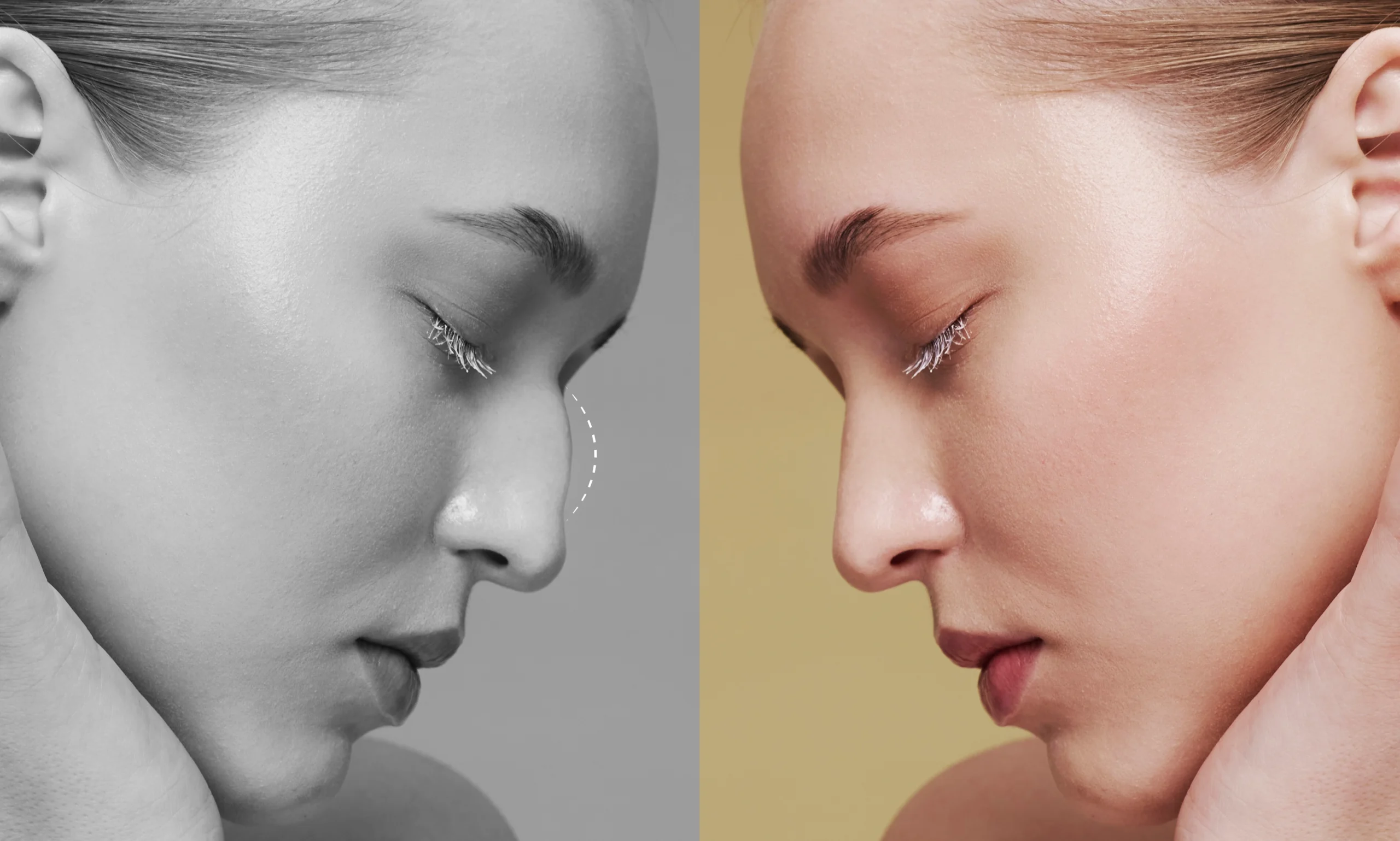 revisionrhinoplasty